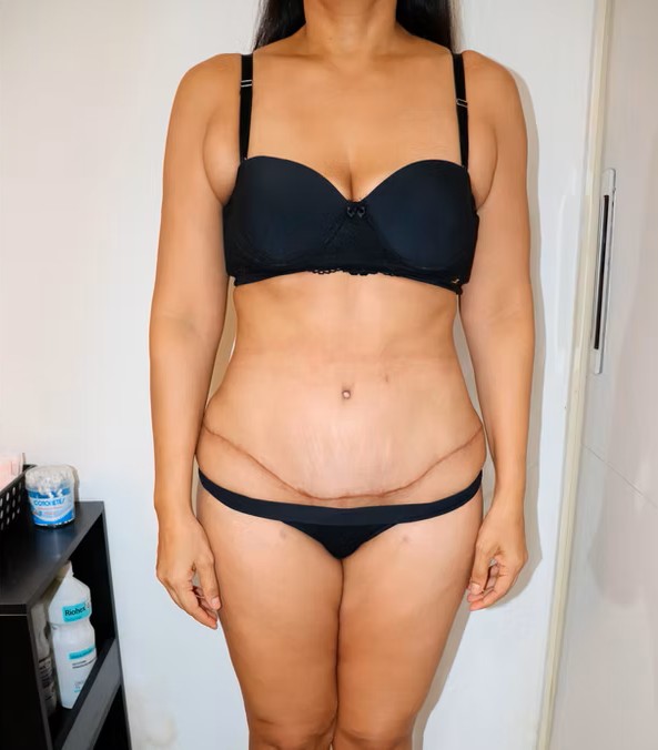 Depois - abdominoplastia completa