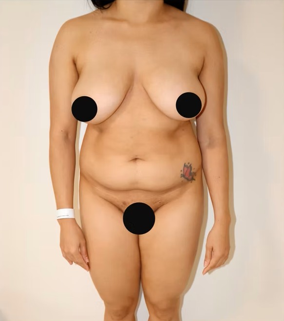 Antes - lipo-abdominoplastia